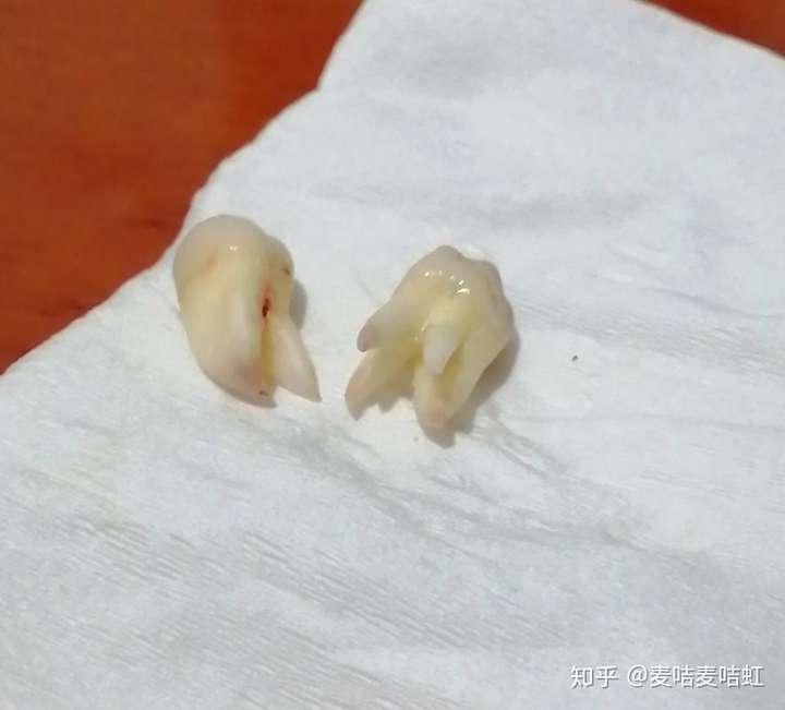 这是我三天前拔的两个对咬的智齿,一个有两个牙根比较好拔,还有一个有