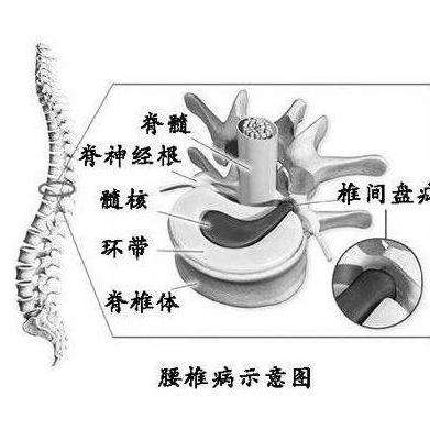 医学上所讲的腰椎病,涵盖了"腰椎间盘突出,腰椎骨质增生,腰肌劳损