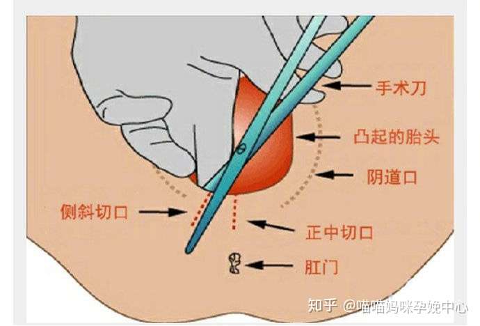 顺产可以不侧切吗?