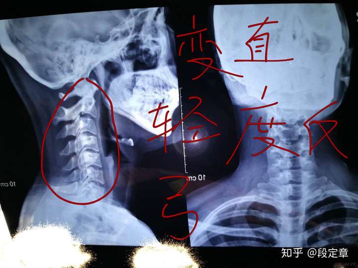 颈弓变直,反弓