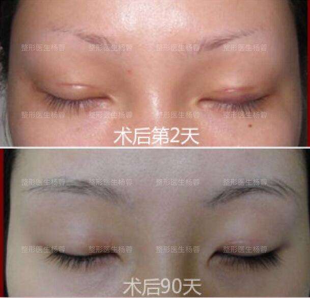 疤痕体质能做双眼皮吗