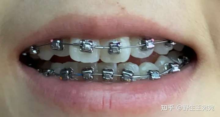 陶瓷牙套:陶瓷非自锁托槽牙套;陶瓷自锁托槽牙套