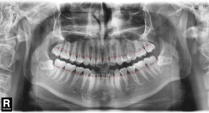 下面这幅图是一个牙周基本正常的人的口腔全景照片.