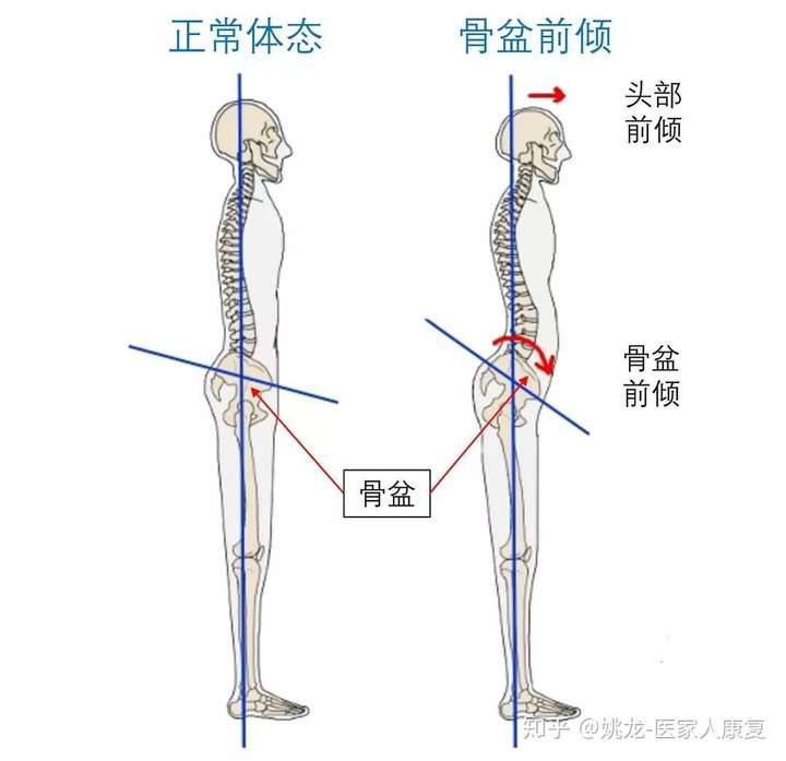 如果骨盆前倾,在侧面观上你可能会观察到: 腰椎前凸,臀部后翘