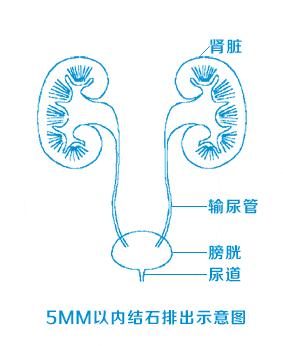 2,位置:在肾盏下方的结石不容易排出,在输尿管,膀胱内的结石容易排出.