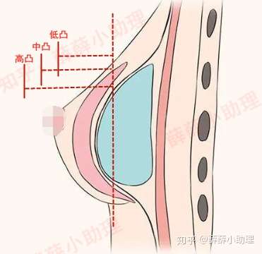 隆胸假体低凸中凸高凸怎么选择?差别在哪?