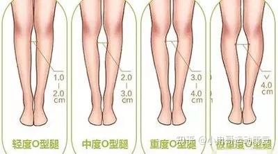 主动膝距就是指直立时,两个脚踝部靠拢,腿部和膝关节向内侧用力并拢