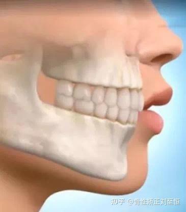 凸嘴类型分为唇性,牙性,骨性或混合性.