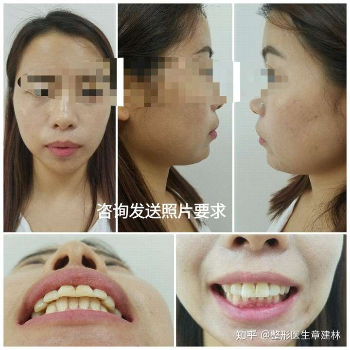 如何判断自己嘴凸?