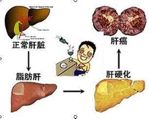 体检查出轻度脂肪肝身体没有不舒服需要如何调整才能降下去