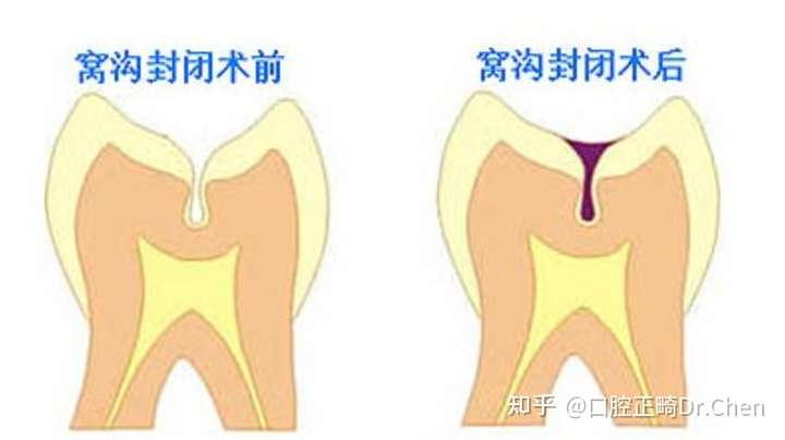 ⑵邻面龋