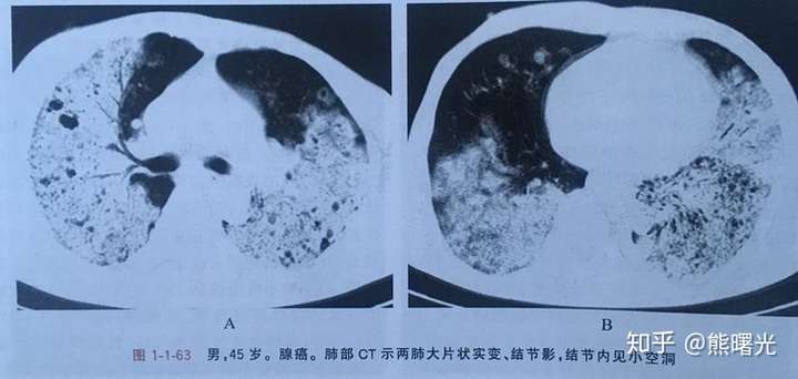 什么是囊腔性肺癌什么是肺炎型肺癌