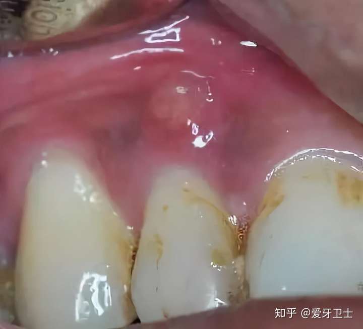 3, 蛀牙引起牙根发炎,牙龈上还会长脓包,医生会拍片检查症状.