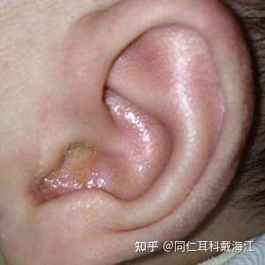 油耳朵的油是怎么来的
