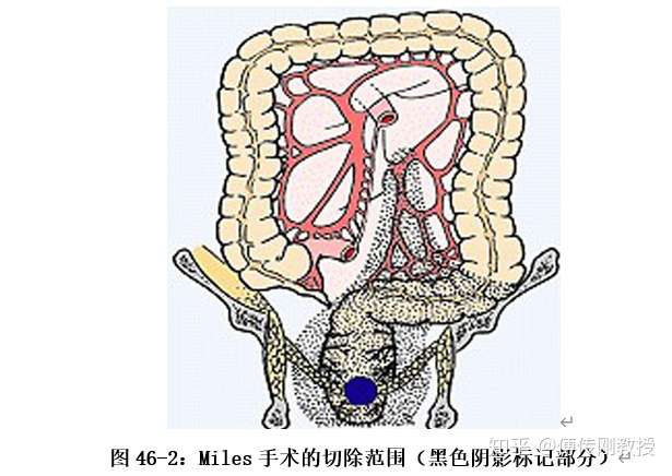 miles手术适用于腹膜返折以下的低位直肠癌.