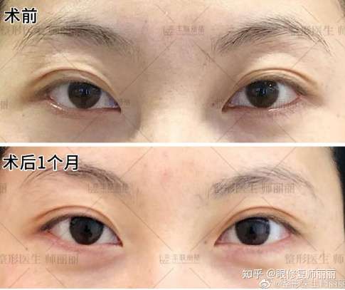 双眼皮埋线好还是割好啊?
