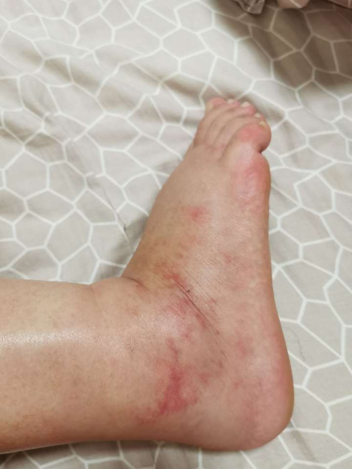 1,脚肿,无比肿,一按一个坑,脚踝处毛细血管都肿破裂那种,肿得皮肤撑