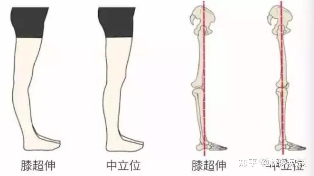 这个种体态是站姿 膝盖过度忘后挺导致的,把小腿后侧,大腿前测多放松