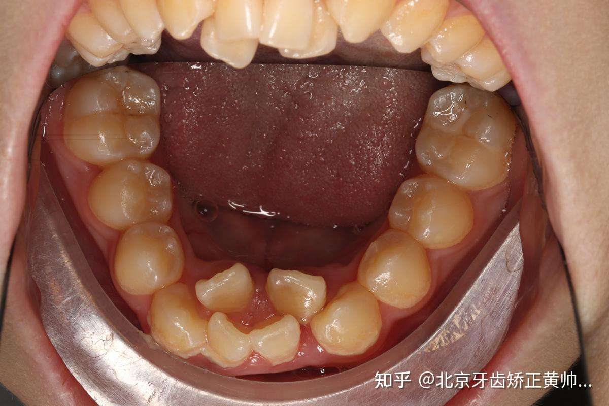 北京牙齿矫正黄帅医生 的想法: 你以为这是双排牙?
