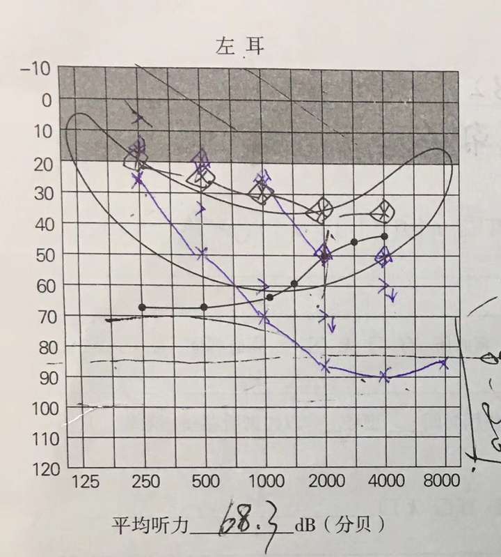 中,高频听力太差会引起啸叫 3.低频的向上掩蔽 4.