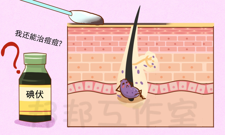 抹碘伏真的可以去痘痘吗?