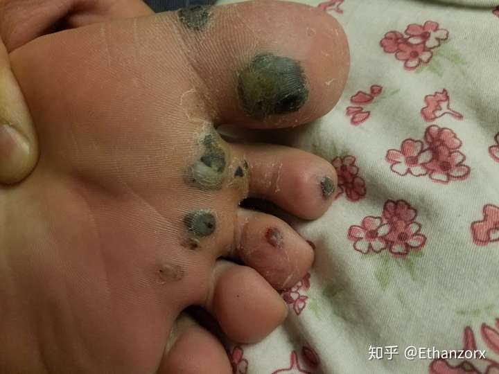 跖疣和鸡眼有什么区别,医学上有没有什么治疗跖疣的好