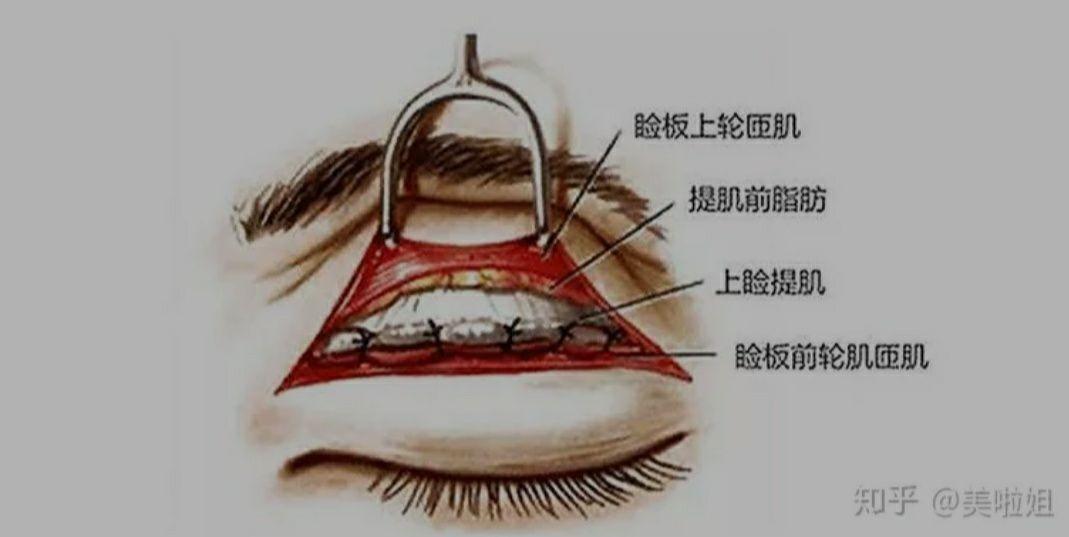 做过双眼皮提肌手术的你们,怎么样了,后悔吗?