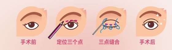 其实这种双眼皮手术方式,并没有韩式和中式之分, 定点双眼皮国内外都