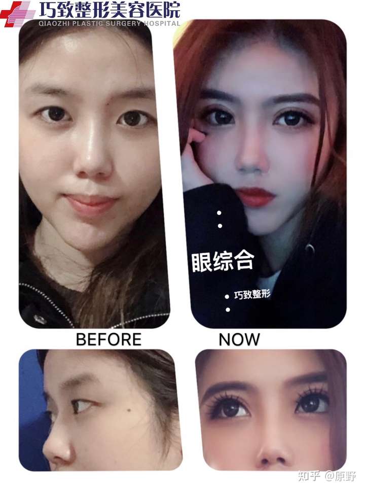 眼综合与普通双眼皮手术有什么区别?