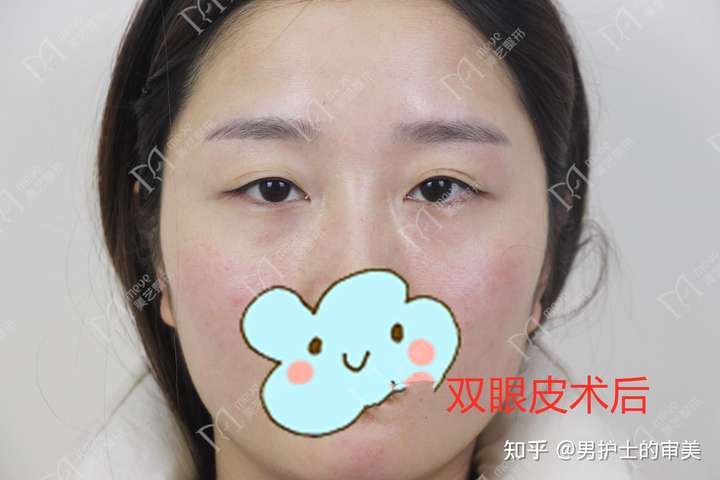 三点式双眼皮可以修复吗?