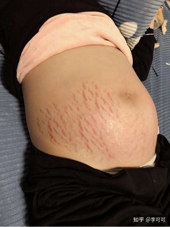 妊娠纹为什么我生完妊娠纹直接变成银白色那种最严重的妊娠纹呢?