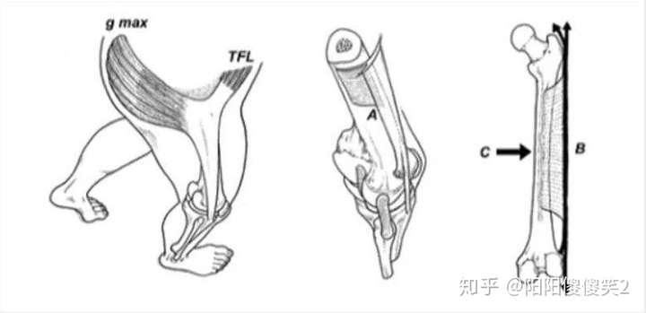 髂胫束综合症的原因和应对策略