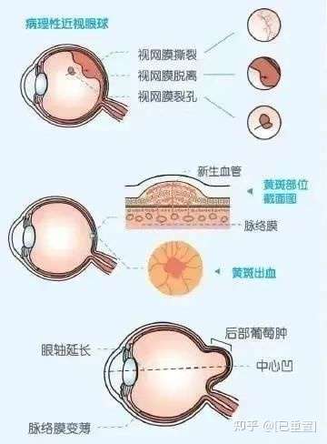 【摩睛科普】为什么已经成年了,近视度数还在不断上涨