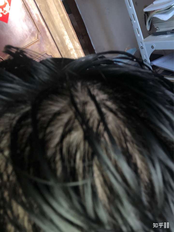 这种头顶发量正常吗?刚洗完头发时候?