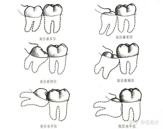 阻生牙牙冠周围的牙龈常常会发炎,疼痛,引起智齿冠周炎,需要抗炎治疗