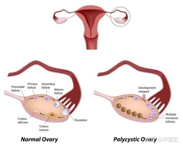 「多囊卵巢综合征」的致病原因是什么,有什么危害?