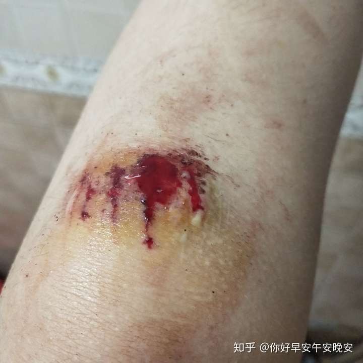 膝盖摔伤抹了碘伏结痂后如何防止留疤