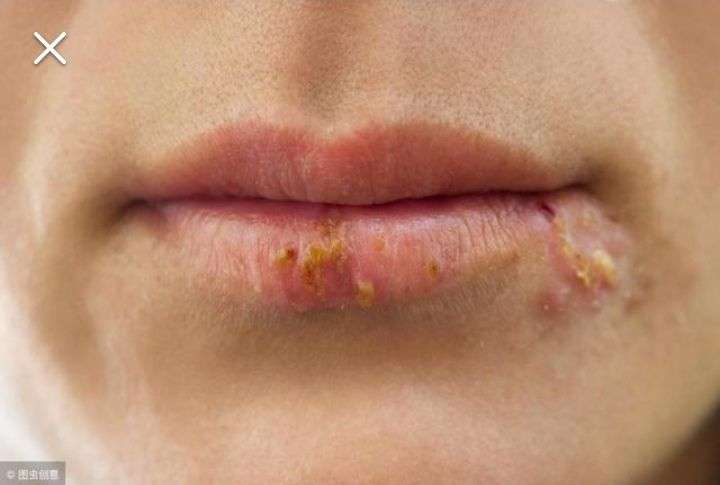 嘴唇疱疹可以用牙膏涂吗?