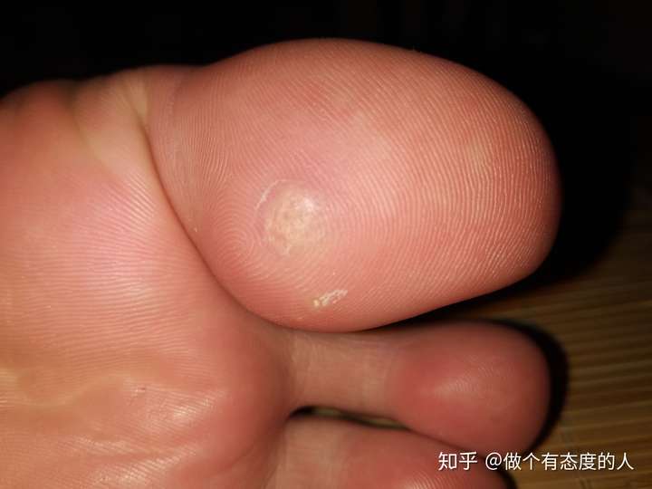 这是我长的跖疣   最开始是以一颗鸡眼造成的   去小诊所挖掉后 就长