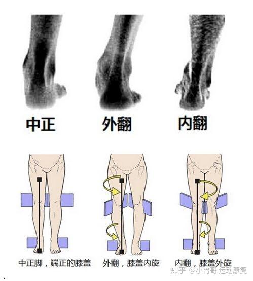 足内翻怎么办