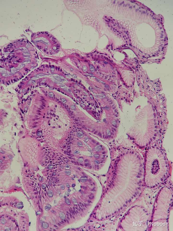 萎缩性胃炎伴腺体肠化,10*40[10倍目镜×40倍物镜].