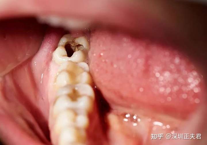 腐烂的牙齿是如何影响我们的健康的?