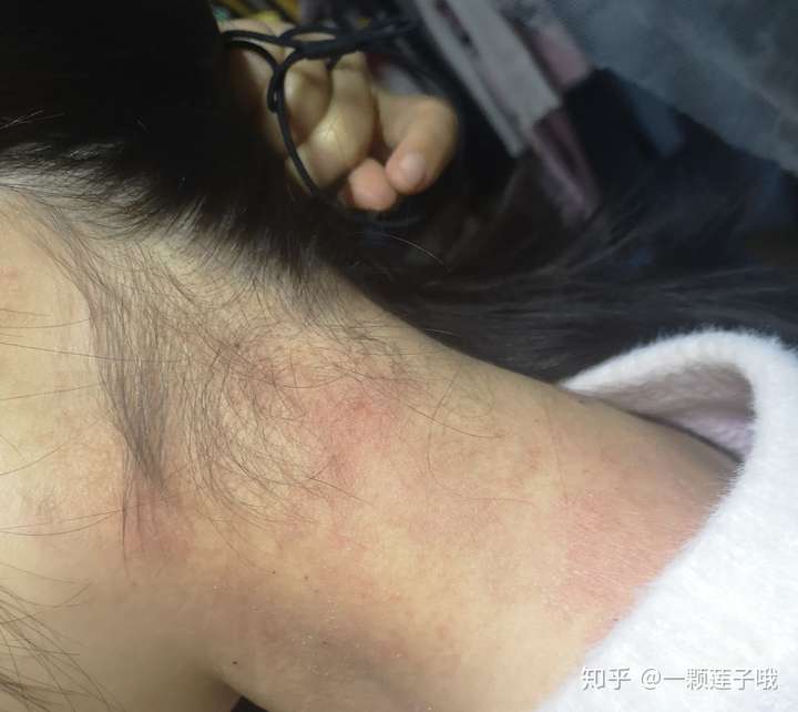 都害怕 (角度问题胳膊没这么粗 ) 我感觉实际更严重写照片有点磨皮