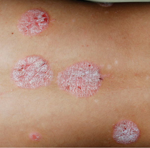 银屑病是一种易复发的红斑鳞屑性慢性皮肤病,俗称牛皮癣.