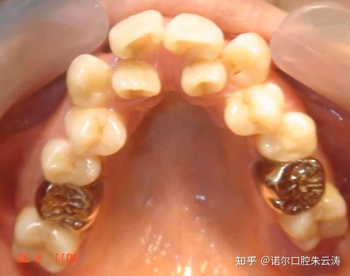 比如这种牙齿都开花了的,不拔怎么办?