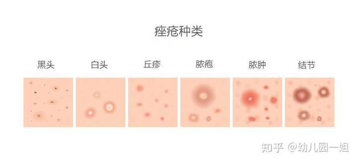 有什么方法可以完全祛痘(一点痘痘不剩的那种)?