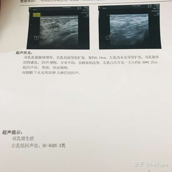 乳腺超声检查报告bi-rads 3级的女人们,你们几岁发现的,目前是良性的