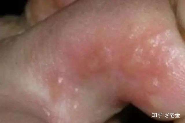 脚上长泡是脚气吗?