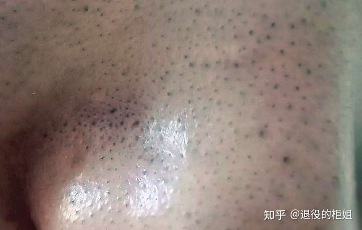 有些是一些毛发,有些是一些孔洞,也有些孔洞发黑,并不是 油脂粒