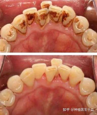 吸烟20年了牙齿烟渍怎么快速去除有什么好办法吗